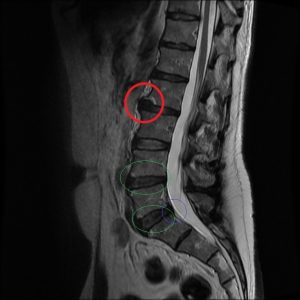 MRI of lower back