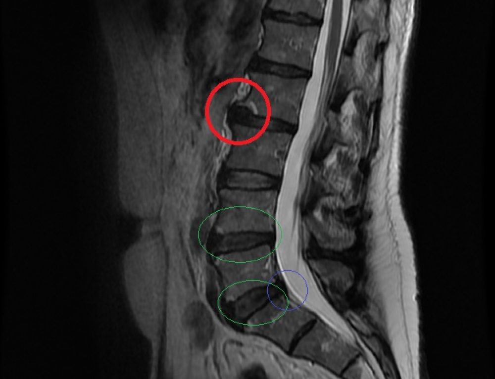 Should I have an MRI or X-ray of my back?